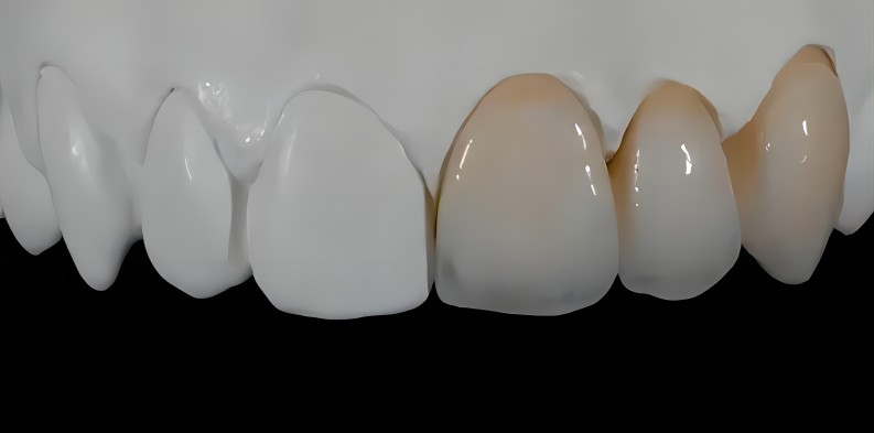 denture porcelain